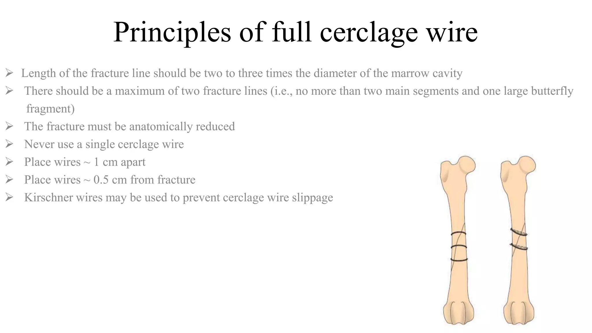 Principles of full cerclage wire
 Length of the fracture line should be two to three times the diameter of the marrow cavity
 There should be a maximum of two fracture lines (i.e., no more than two main segments and one large butterfly
fragment)
 The fracture must be anatomically reduced
 Never use a single cerclage wire
 Place wires ~ 1 cm apart
 Place wires ~ 0.5 cm from fracture
 Kirschner wires may be used to prevent cerclage wire slippage
 