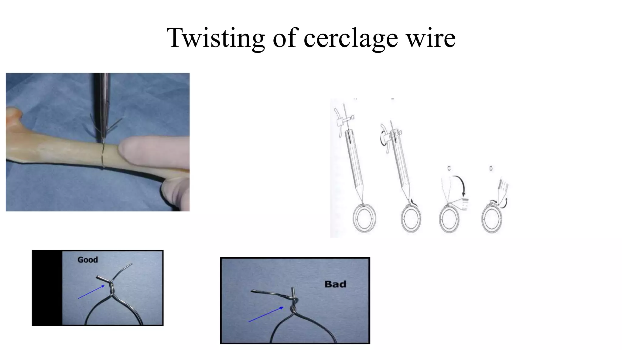 Twisting of cerclage wire
 