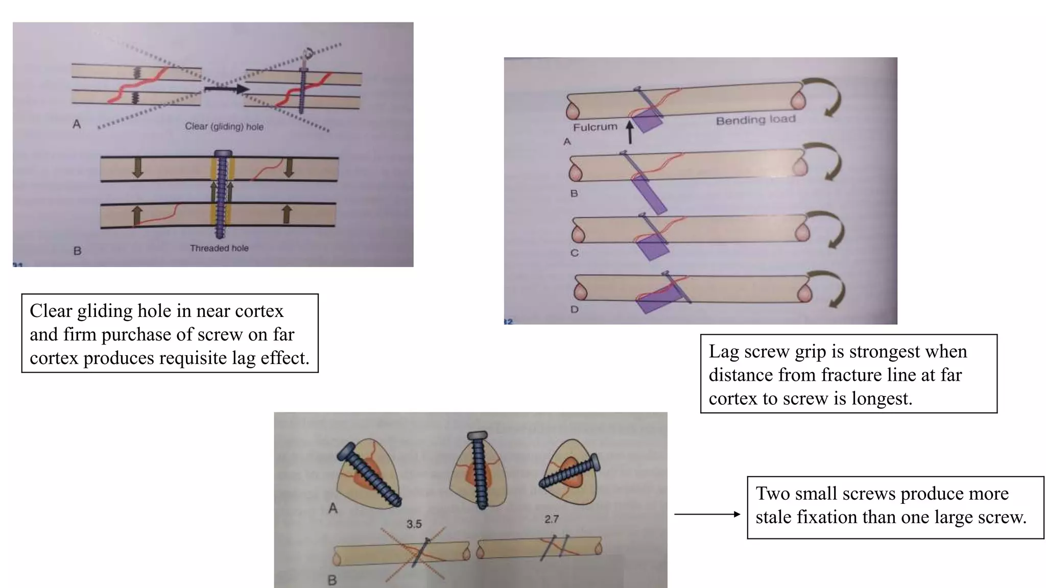 →
Two small screws produce more
stale fixation than one large screw.
Clear gliding hole in near cortex
and firm purchase of screw on far
cortex produces requisite lag effect. Lag screw grip is strongest when
distance from fracture line at far
cortex to screw is longest.
 