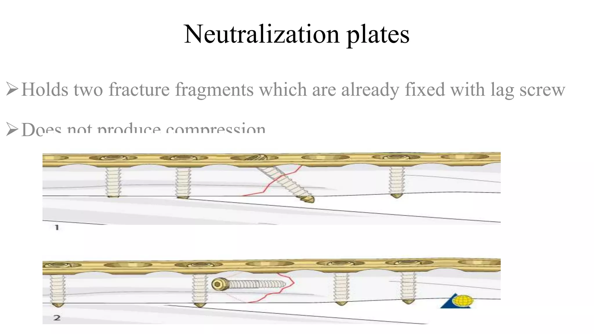 Neutralization plates
Holds two fracture fragments which are already fixed with lag screw
Does not produce compression
 
