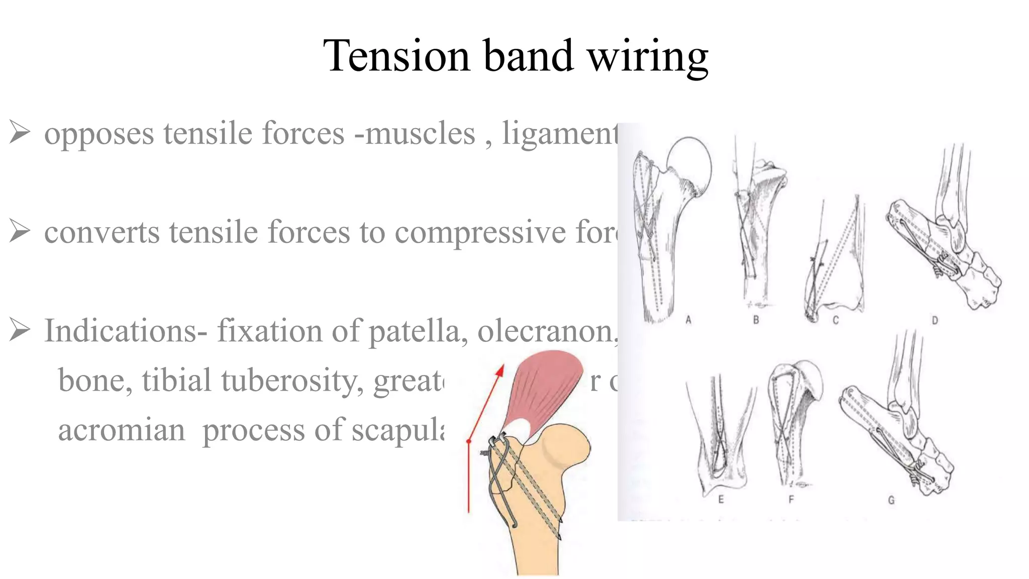 Tension band wiring
 opposes tensile forces -muscles , ligaments.
 converts tensile forces to compressive forces.
 Indications- fixation of patella, olecranon, fibular tarsal
bone, tibial tuberosity, greater trochantr of femur,
acromian process of scapula.
 