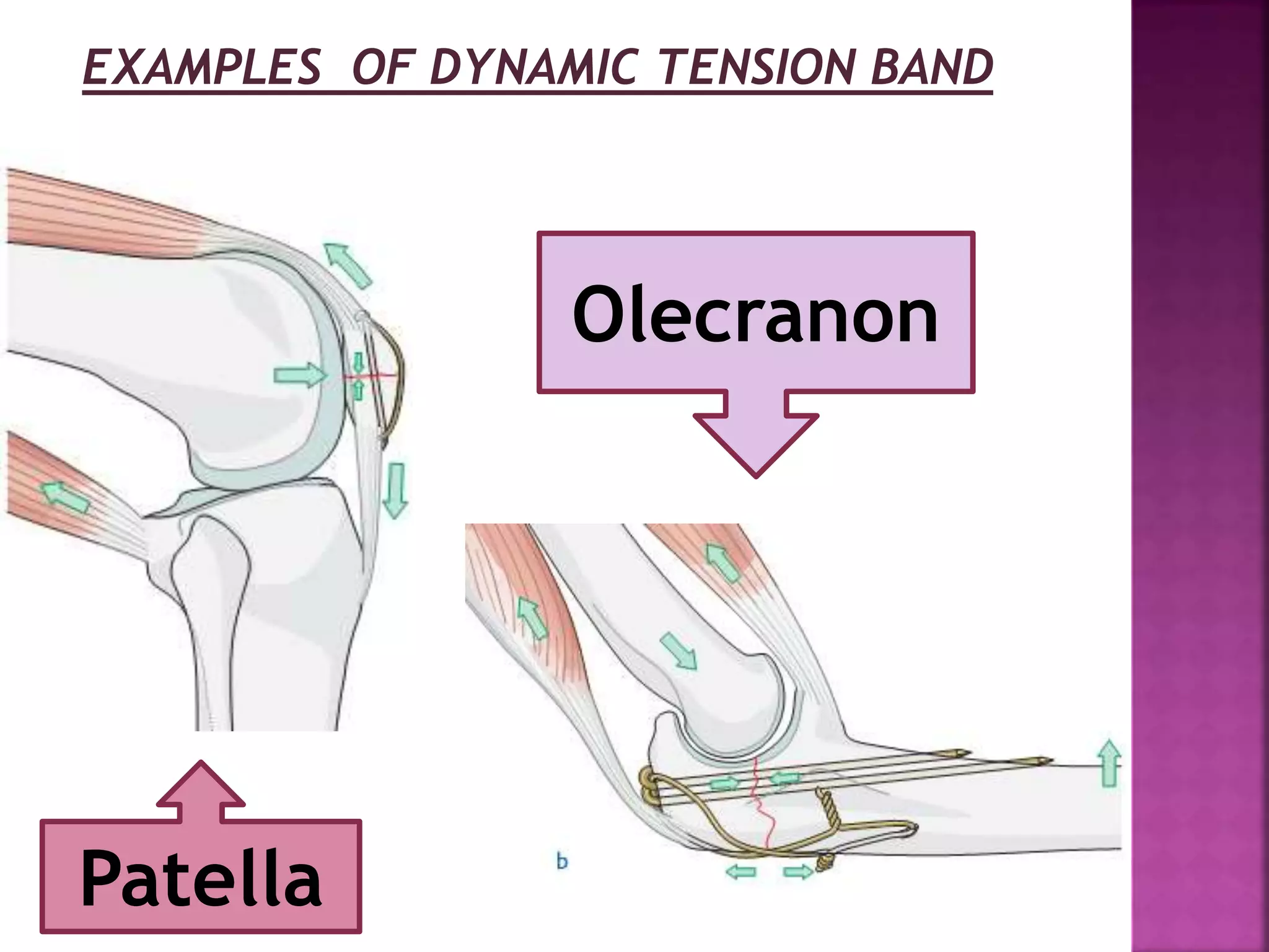 Patella
Olecranon
EXAMPLES OF DYNAMIC TENSION BAND
 