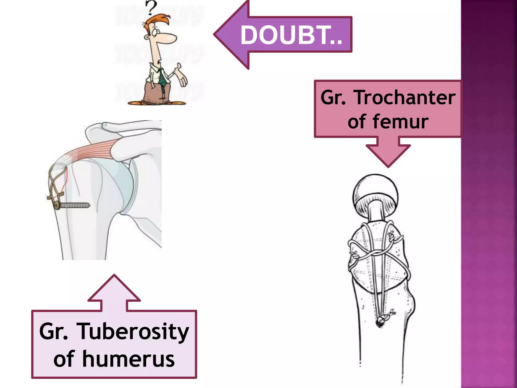 Gr. Tuberosity
of humerus
Gr. Trochanter
of femur
DOUBT..
....
 