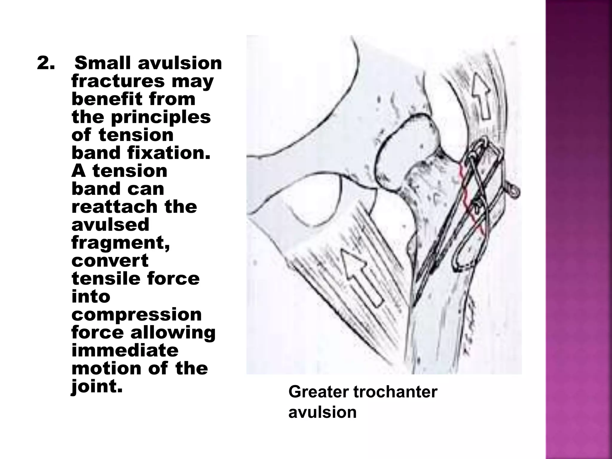 2. Small avulsion
fractures may
benefit from
the principles
of tension
band fixation.
A tension
band can
reattach the
avulsed
fragment,
convert
tensile force
into
compression
force allowing
immediate
motion of the
joint. Greater trochanter
avulsion
 
