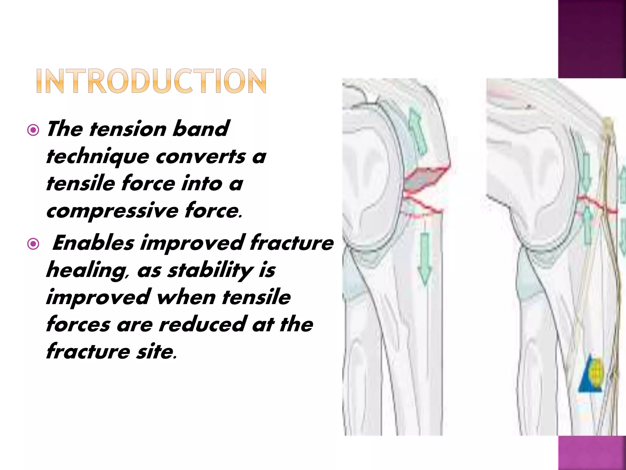  The tension band
technique converts a
tensile force into a
compressive force.
 Enables improved fracture
healing, as stability is
improved when tensile
forces are reduced at the
fracture site.
 
