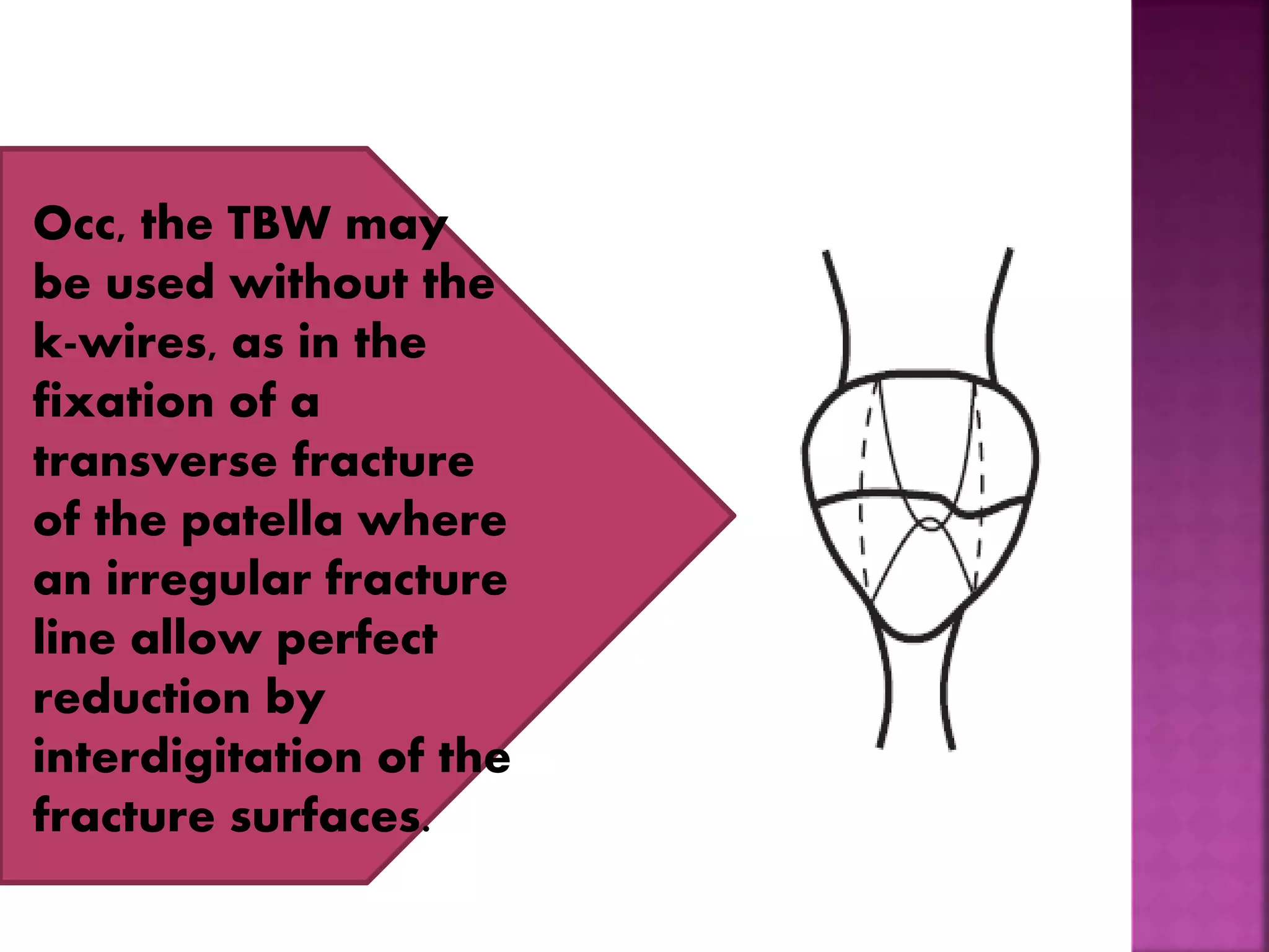 Occ, the TBW may
be used without the
k-wires, as in the
fixation of a
transverse fracture
of the patella where
an irregular fracture
line allow perfect
reduction by
interdigitation of the
fracture surfaces.
 