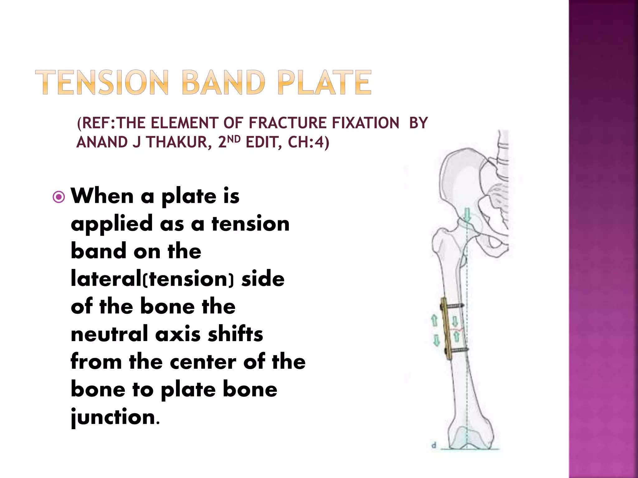  When a plate is
applied as a tension
band on the
lateral(tension) side
of the bone the
neutral axis shifts
from the center of the
bone to plate bone
junction.
(REF:THE ELEMENT OF FRACTURE FIXATION BY
ANAND J THAKUR, 2ND EDIT, CH:4)
 