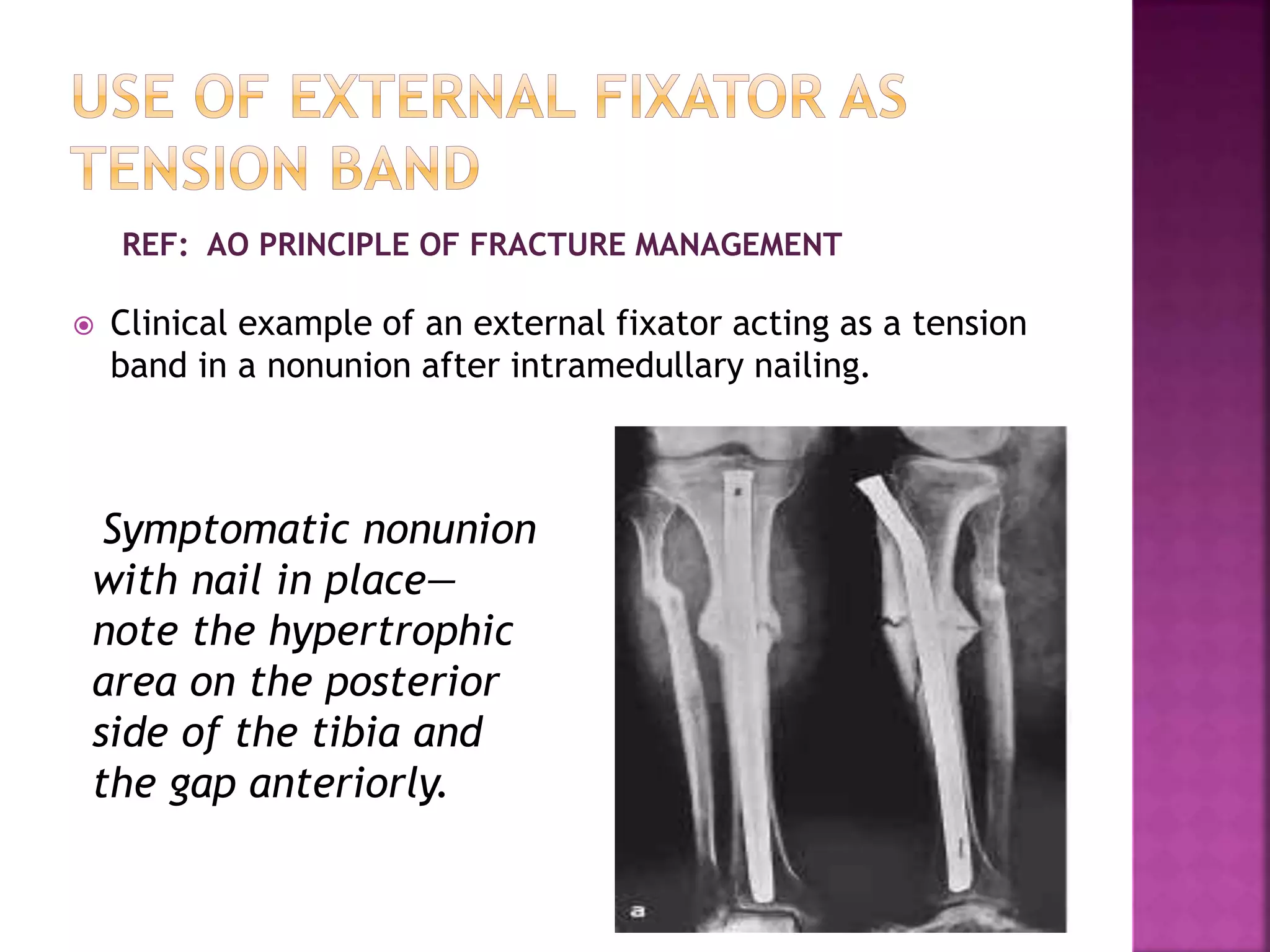  Clinical example of an external fixator acting as a tension
band in a nonunion after intramedullary nailing.
REF: AO PRINCIPLE OF FRACTURE MANAGEMENT
Symptomatic nonunion
with nail in place—
note the hypertrophic
area on the posterior
side of the tibia and
the gap anteriorly.
 