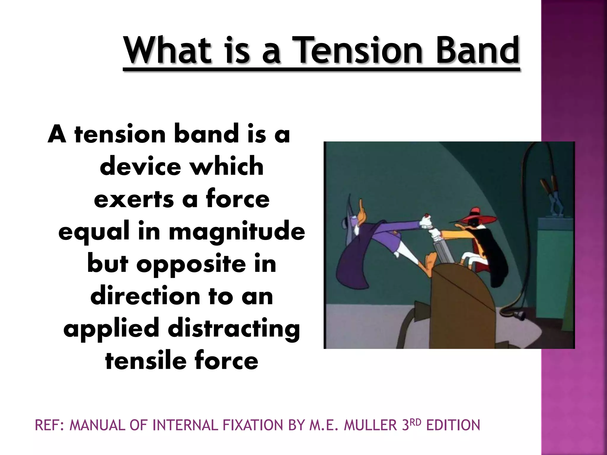 What is a Tension Band
A tension band is a
device which
exerts a force
equal in magnitude
but opposite in
direction to an
applied distracting
tensile force
REF: MANUAL OF INTERNAL FIXATION BY M.E. MULLER 3RD EDITION
 