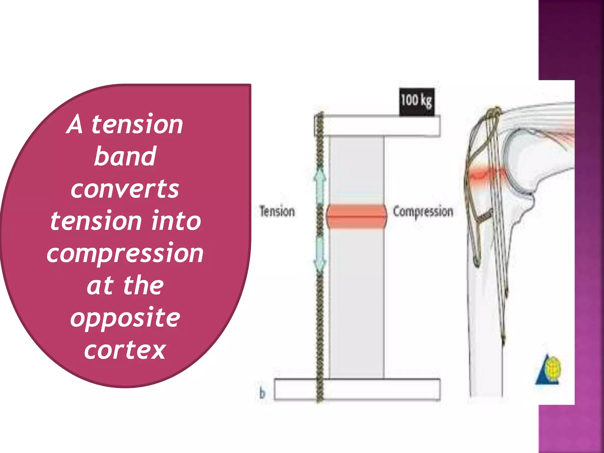 A tension
band
converts
tension into
compression
at the
opposite
cortex
 