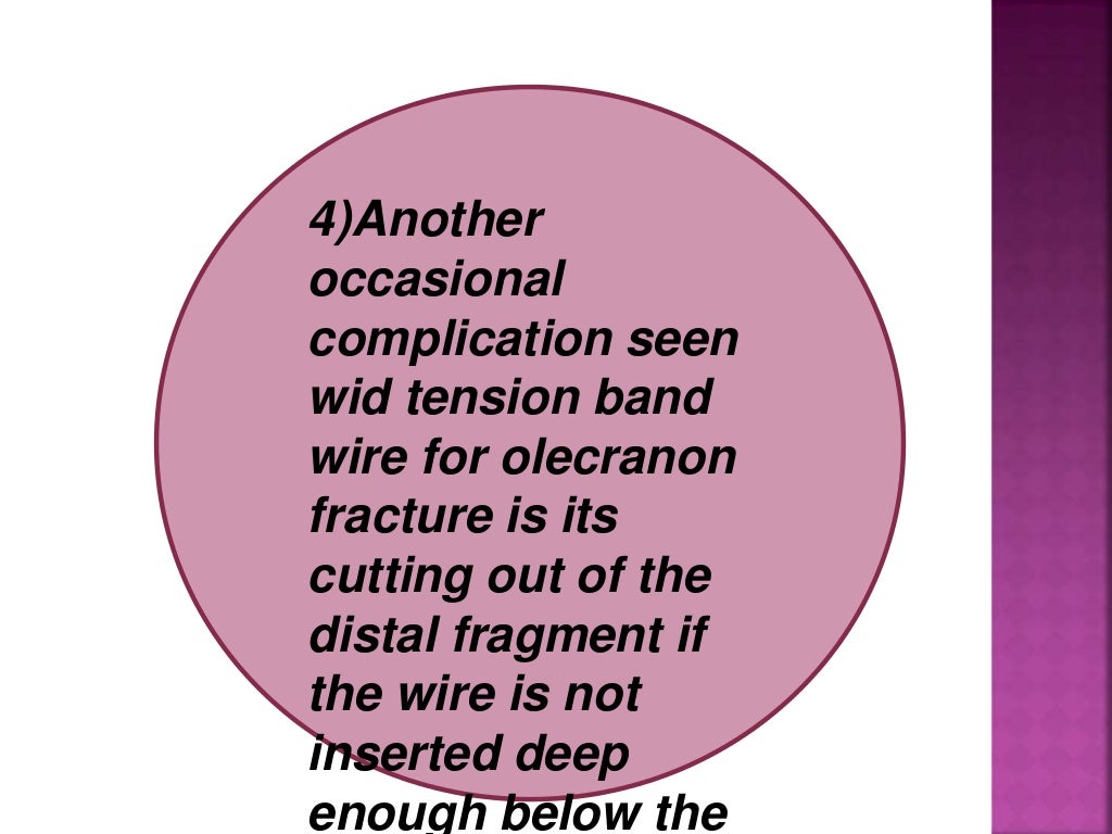 Principle of tension band wiring n its application