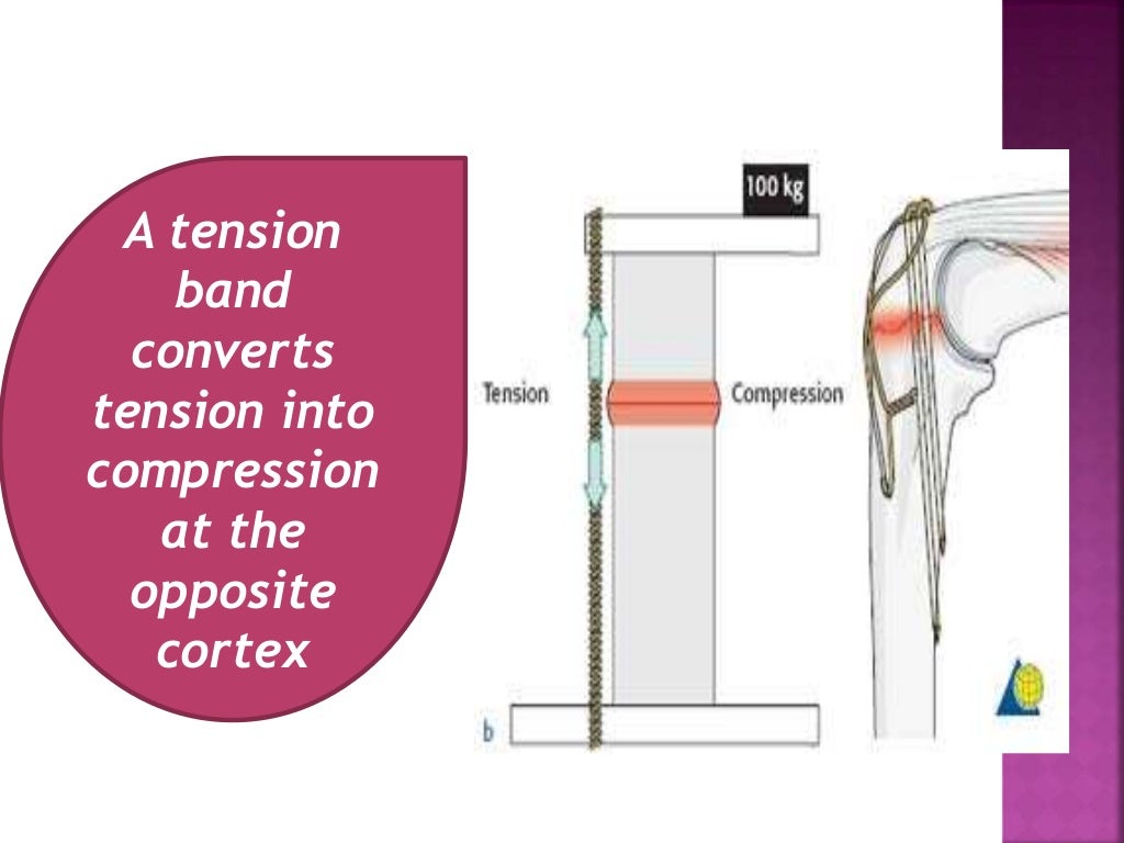 Principle of tension band wiring n its application