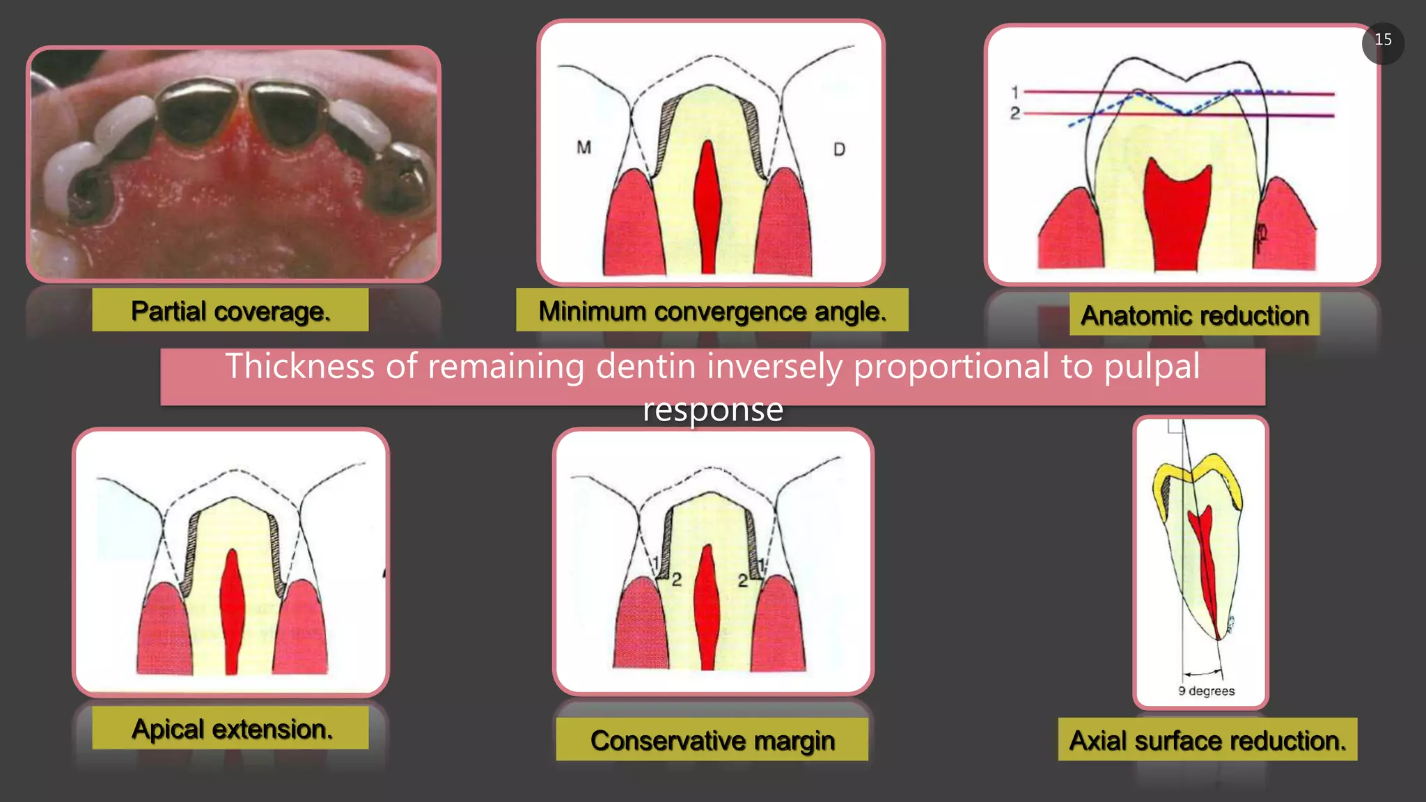 Partial coverage. Minimum convergence angle. Anatomic reduction
Axial surface reduction.Apical extension. Conservative margin
Thickness of remaining dentin inversely proportional to pulpal
response
15
 