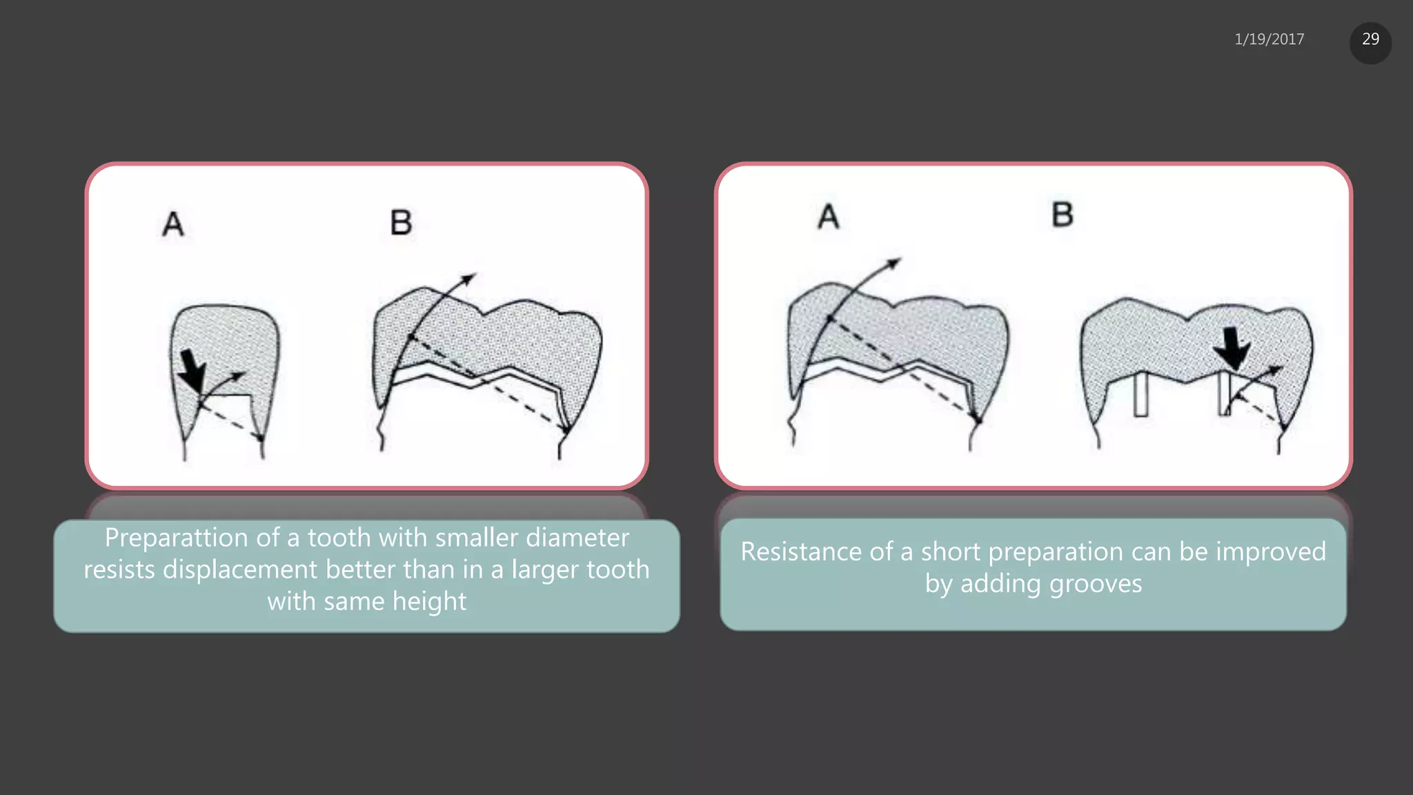 Preparattion of a tooth with smaller diameter
resists displacement better than in a larger tooth
with same height
Resistance of a short preparation can be improved
by adding grooves
29
 