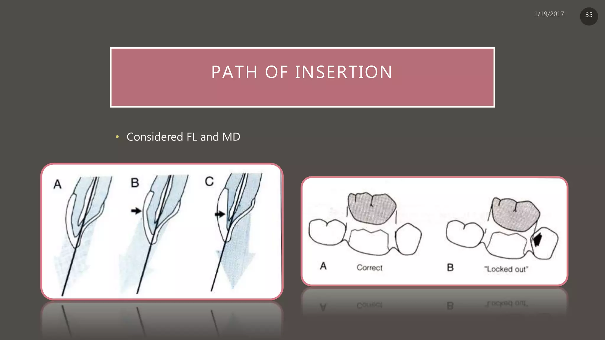 PATH OF INSERTION
• Considered FL and MD
35
 