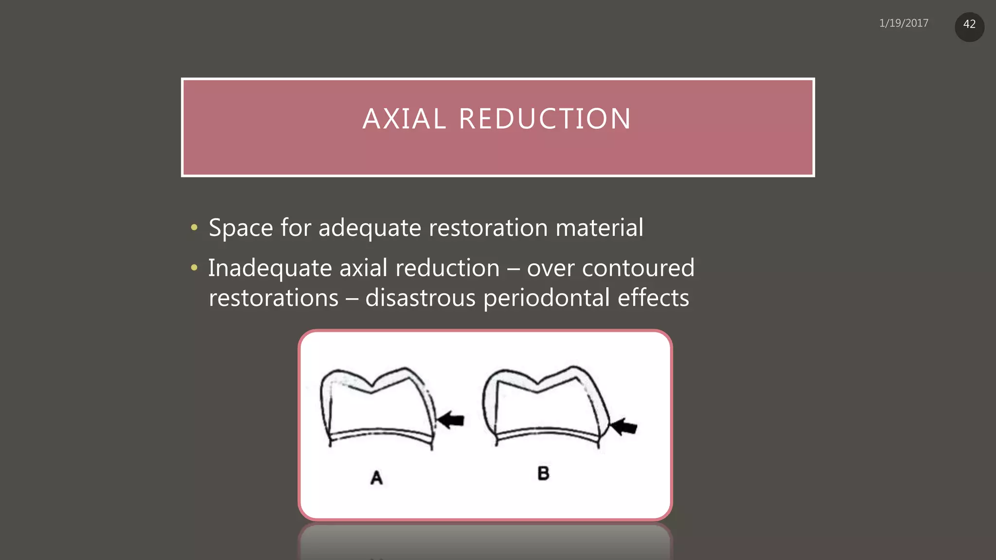 AXIAL REDUCTION
• Space for adequate restoration material
• Inadequate axial reduction – over contoured
restorations – disastrous periodontal effects
42
 
