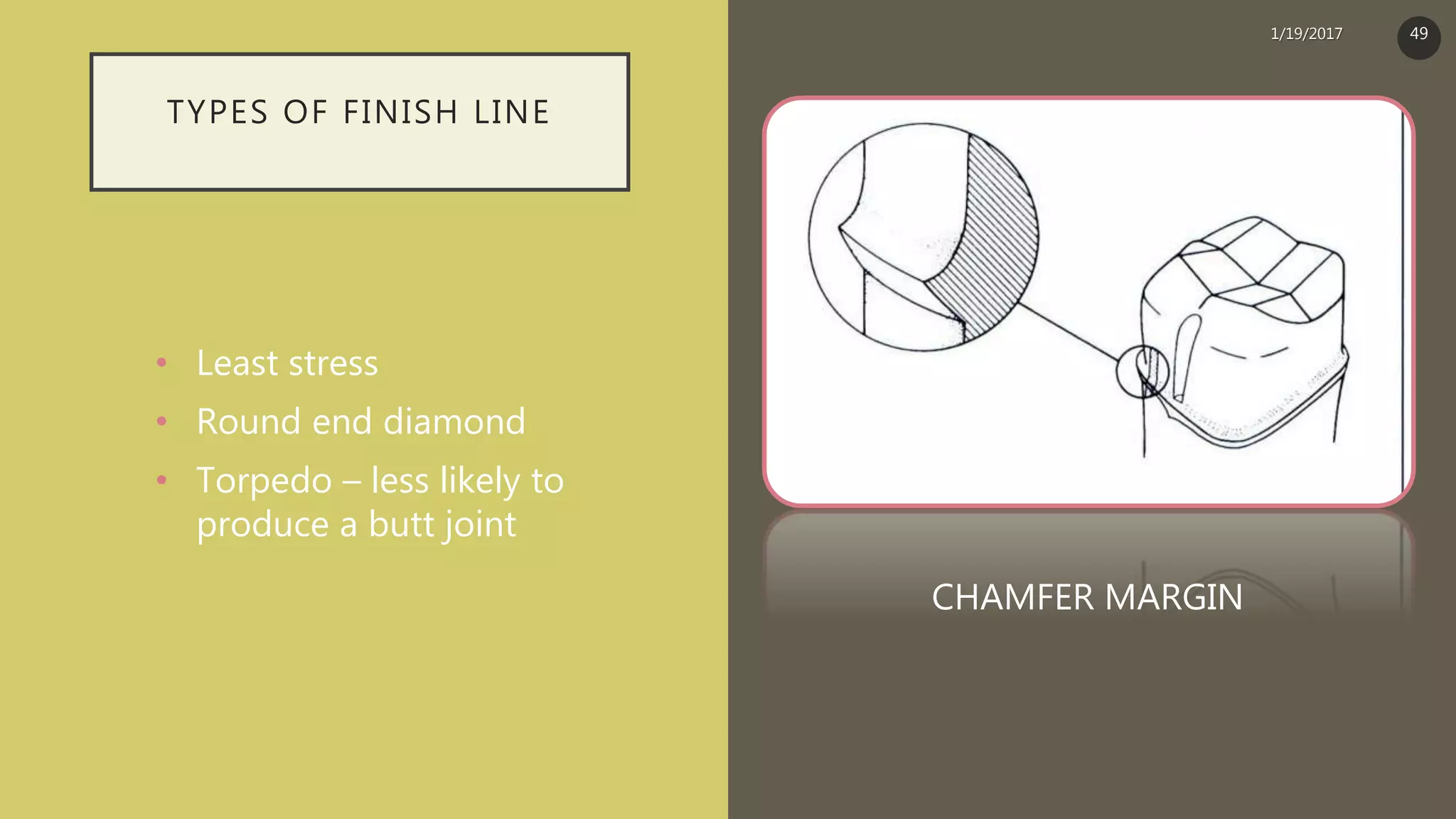 TYPES OF FINISH LINE
• Least stress
• Round end diamond
• Torpedo – less likely to
produce a butt joint
CHAMFER MARGIN
1/19/2017 49
 