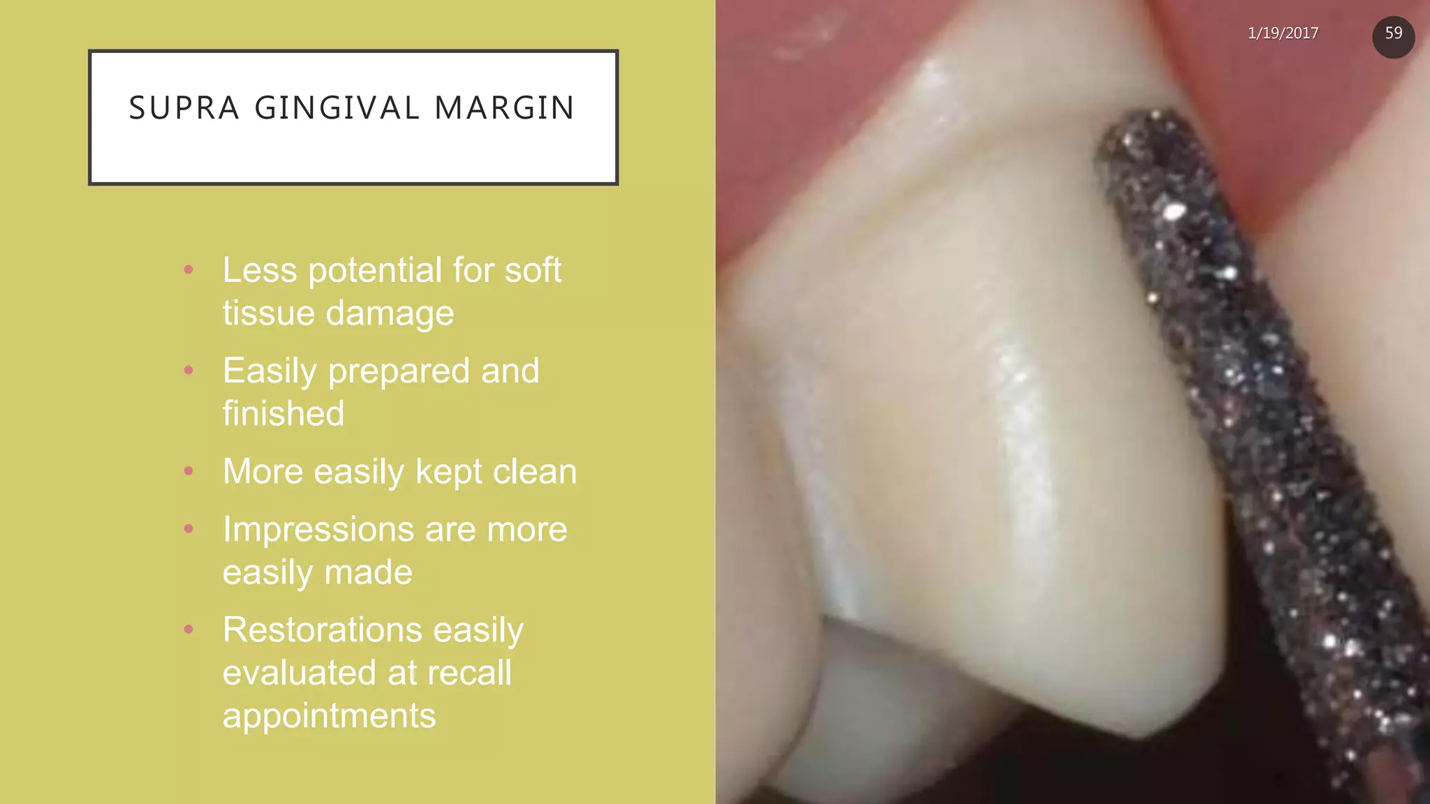 SUPRA GINGIVAL MARGIN
• Less potential for soft
tissue damage
• Easily prepared and
finished
• More easily kept clean
• Impressions are more
easily made
• Restorations easily
evaluated at recall
appointments
1/19/2017 59
 