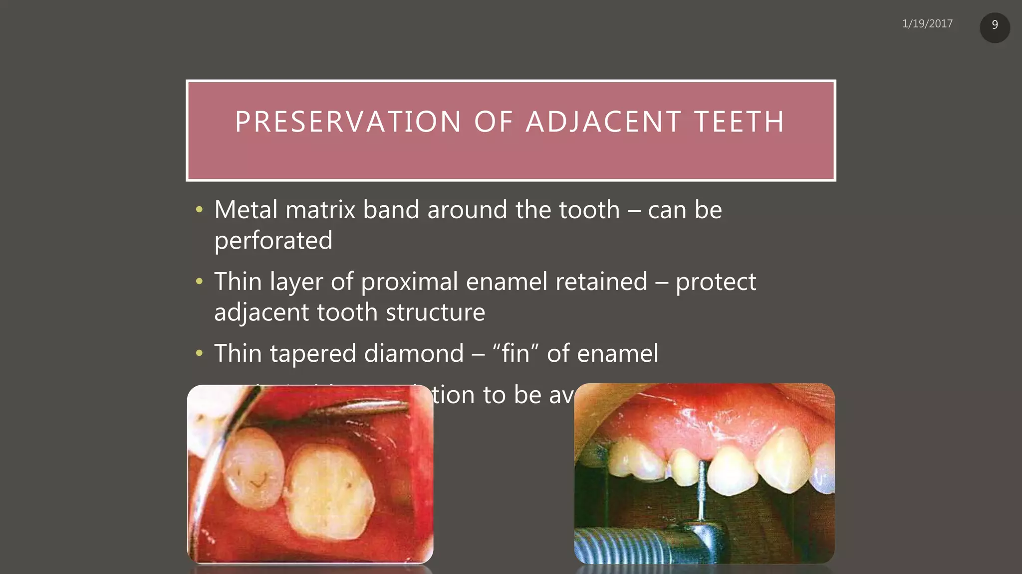 PRESERVATION OF ADJACENT TEETH
• Metal matrix band around the tooth – can be
perforated
• Thin layer of proximal enamel retained – protect
adjacent tooth structure
• Thin tapered diamond – “fin” of enamel
• Undesirable angulation to be avoided
9
 
