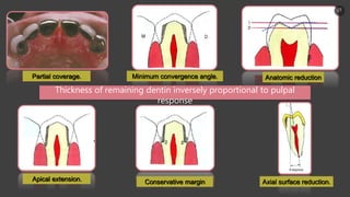 Partial coverage. Minimum convergence angle. Anatomic reduction
Axial surface reduction.Apical extension. Conservative margin
Thickness of remaining dentin inversely proportional to pulpal
response
15
 