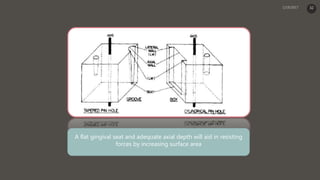 A flat gingival seat and adequate axial depth will aid in resisting
forces by increasing surface area
32
 