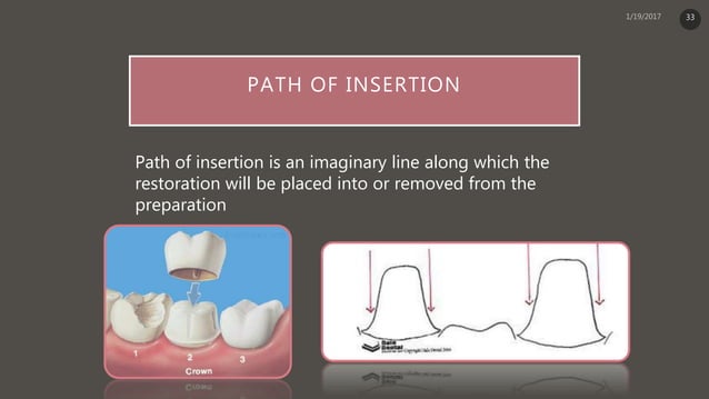 Principle of tooth preparation | PPTX | Dental Health | Diseases and ...