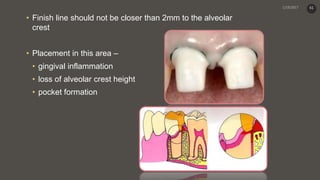 • Finish line should not be closer than 2mm to the alveolar
crest
• Placement in this area –
• gingival inflammation
• loss of alveolar crest height
• pocket formation
61
 
