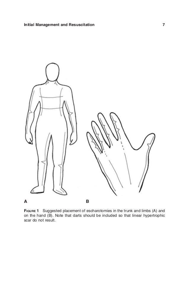 Principles.and.practice.of.burn.surgery.3 haxap