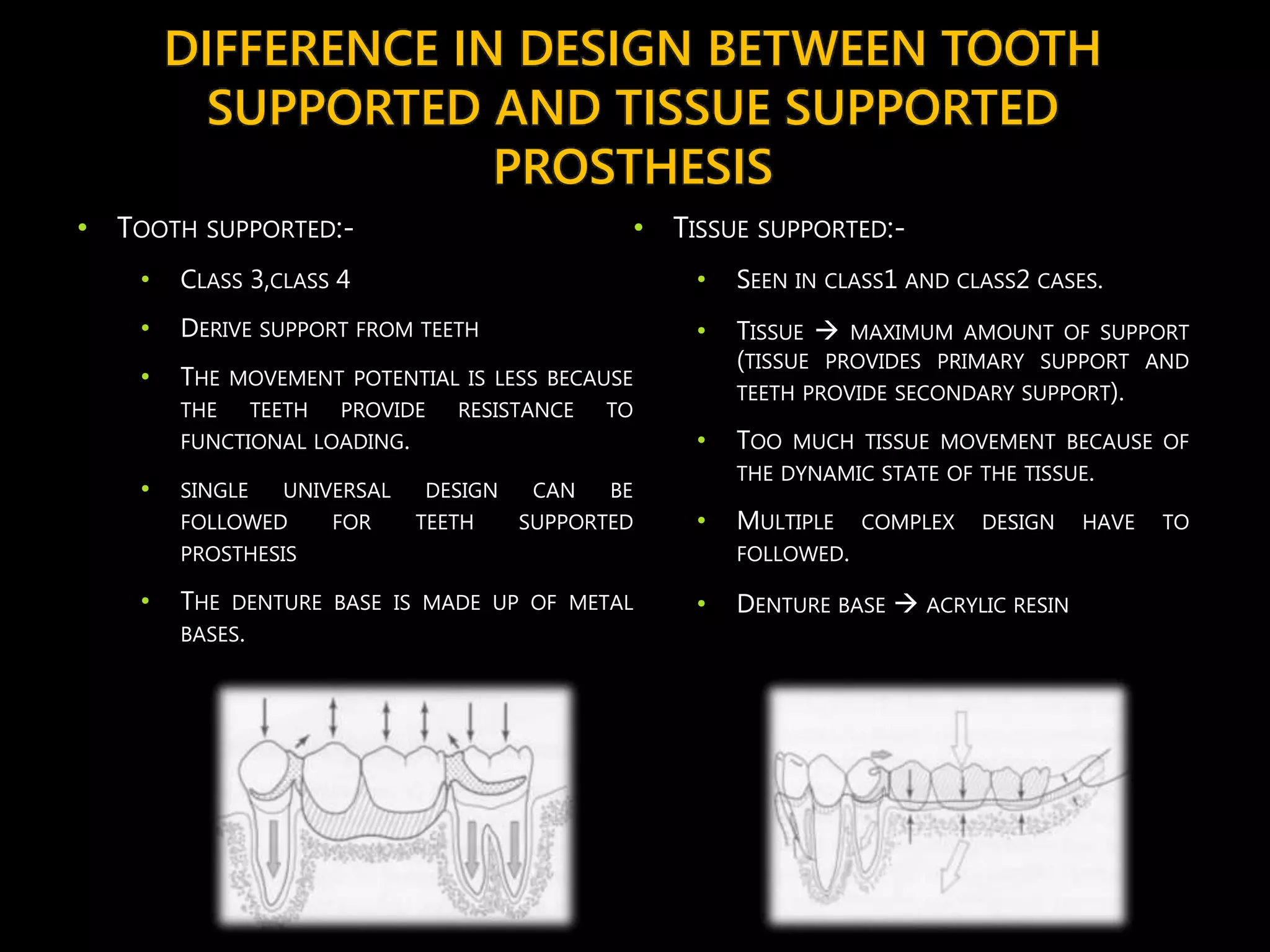 Principles of designing in Removable Partial dentures | PPTX