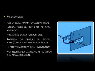 Principles of designing in Removable Partial dentures | PPTX