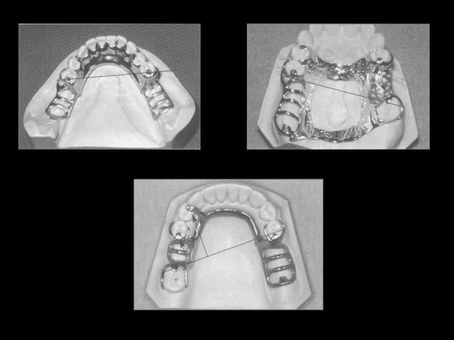 Principles of designing in Removable Partial dentures | PPTX