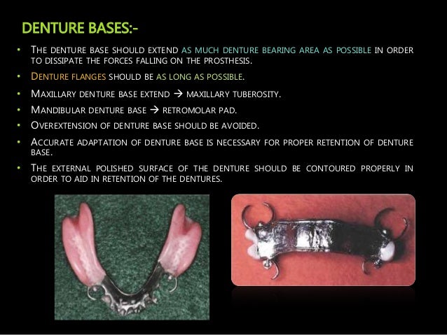 principles of designing in removable partial dentures removable partial denture design