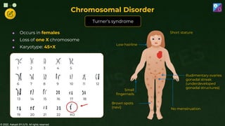 © 2022, Aakash BYJU'S. All rights reserved
6 7 8 9 10 11 12
1 2 3 4 5
19 20 21 22 XO
13 14 15 16 17 18
 Occurs in females
 Loss of one X chromosome
 Karyotype: 45+X
No menstruation
Rudimentary ovaries
gonadal streak
(underdeveloped
gonadal structures)
Low hairline
Small
fingernails
Brown spots
(nevi)
Short stature
Turner’s syndrome
Chromosomal Disorder
 