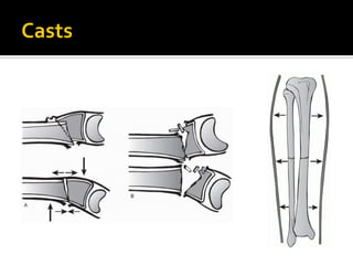Principles and conservative treatment of fractures.2560