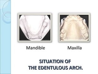 Mandible      Maxilla

    SITUATION OF
THE EDENTULOUS ARCH.
 