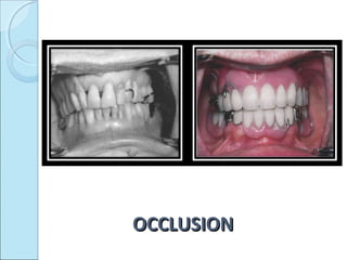 OCCLUSION
 
