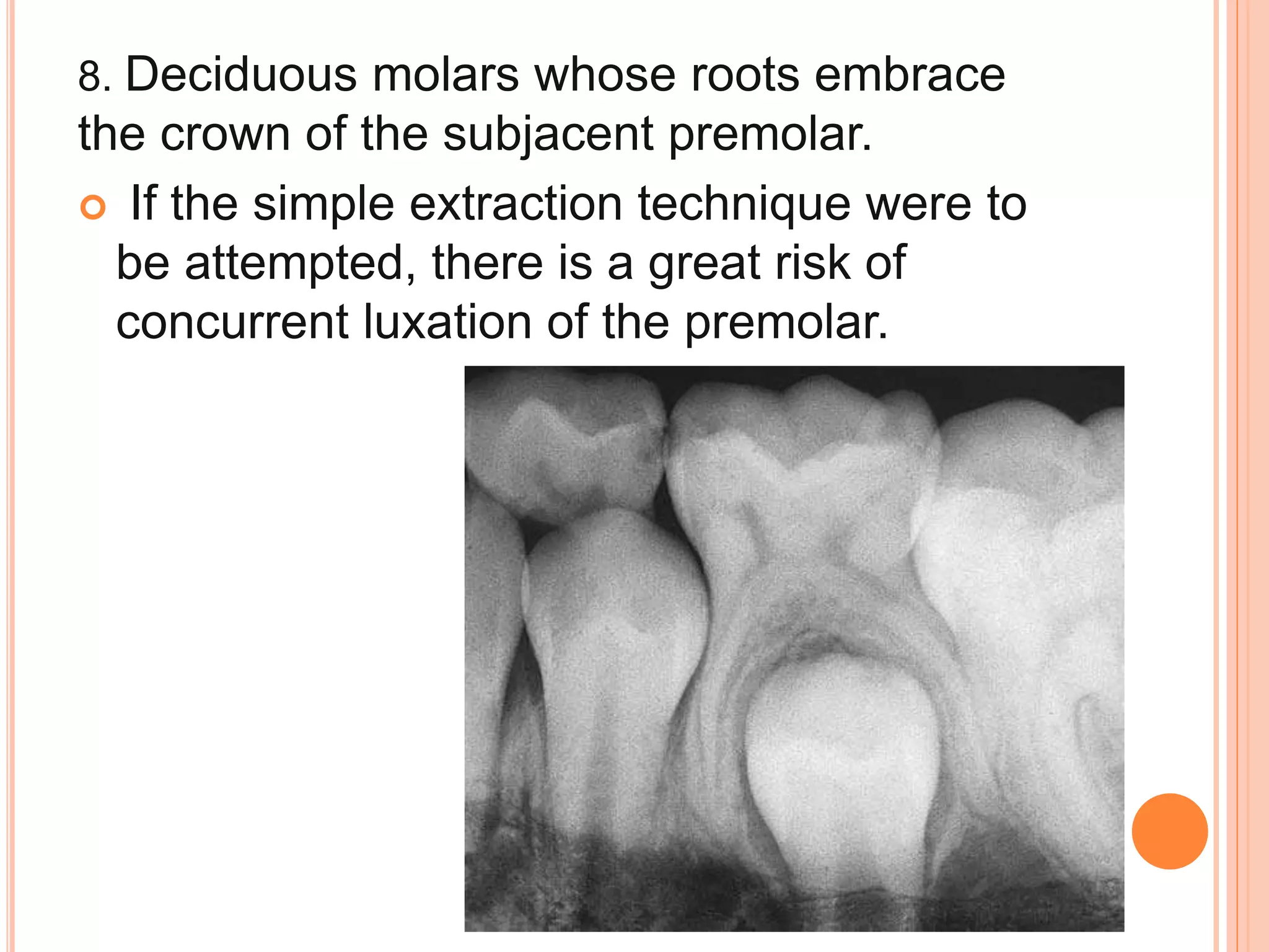8. Deciduous molars whose roots embrace
the crown of the subjacent premolar.
 If the simple extraction technique were to
be attempted, there is a great risk of
concurrent luxation of the premolar.
 