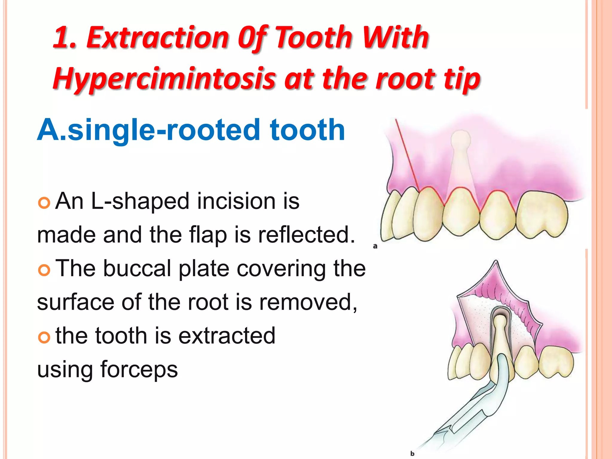 A.single-rooted tooth
 An L-shaped incision is
made and the flap is reflected.
 The buccal plate covering the
surface of the root is removed,
 the tooth is extracted
using forceps
1. Extraction 0f Tooth With
Hypercimintosis at the root tip
 