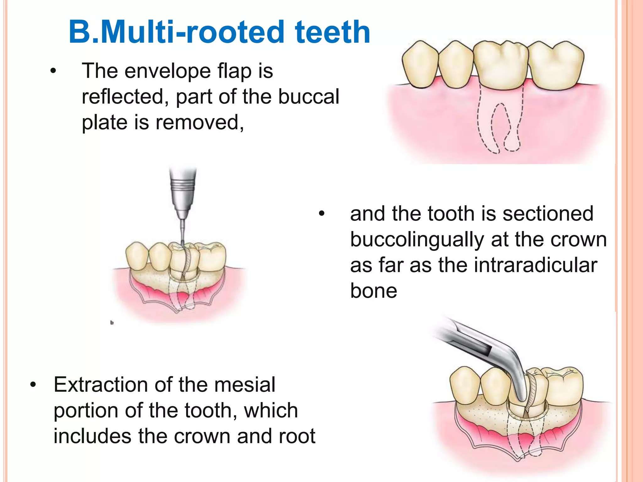 B.Multi-rooted teeth
• The envelope flap is
reflected, part of the buccal
plate is removed,
• Extraction of the mesial
portion of the tooth, which
includes the crown and root
• and the tooth is sectioned
buccolingually at the crown
as far as the intraradicular
bone
 