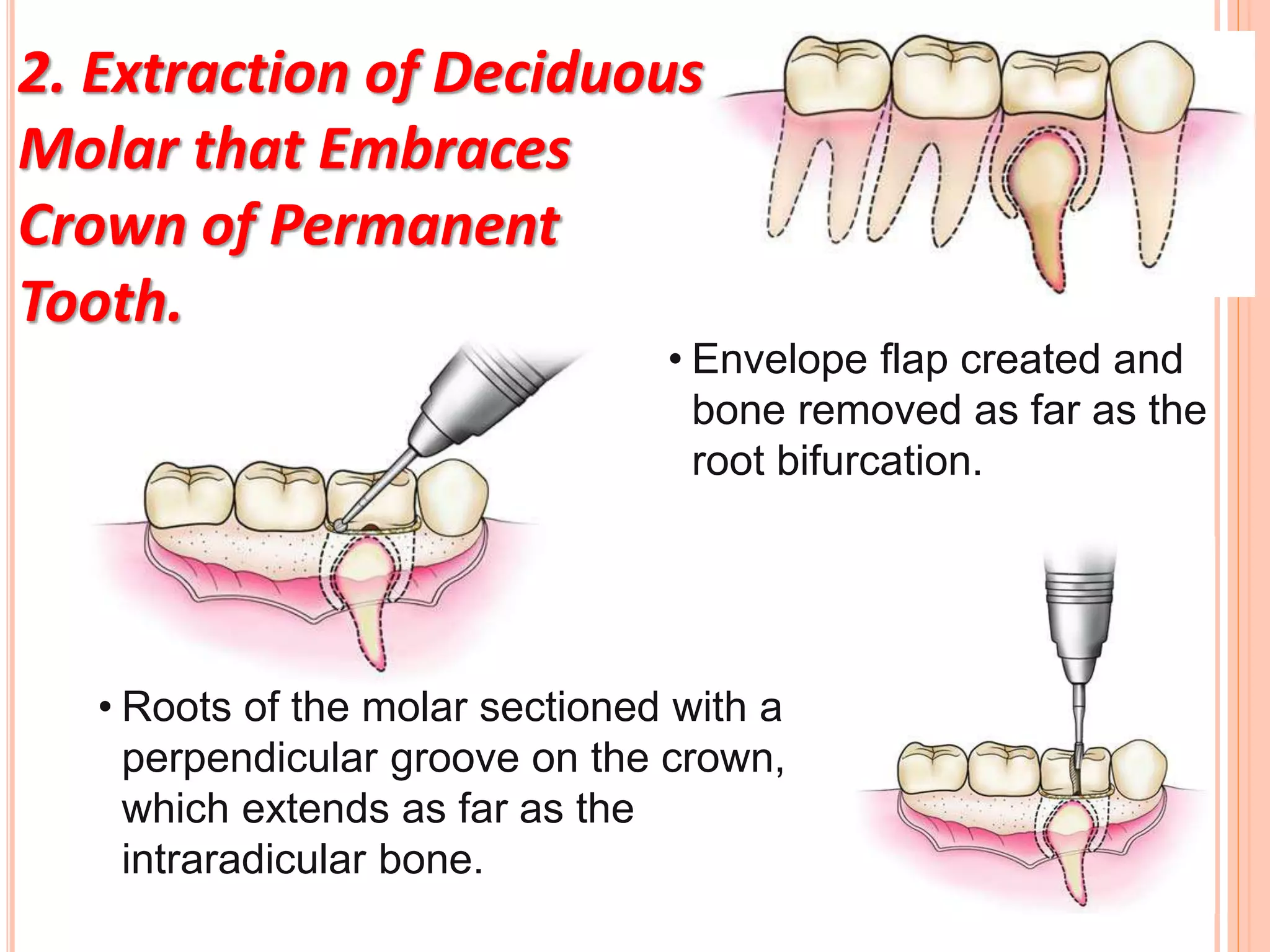 2. Extraction of Deciduous
Molar that Embraces
Crown of Permanent
Tooth.
• Envelope flap created and
bone removed as far as the
root bifurcation.
• Roots of the molar sectioned with a
perpendicular groove on the crown,
which extends as far as the
intraradicular bone.
 