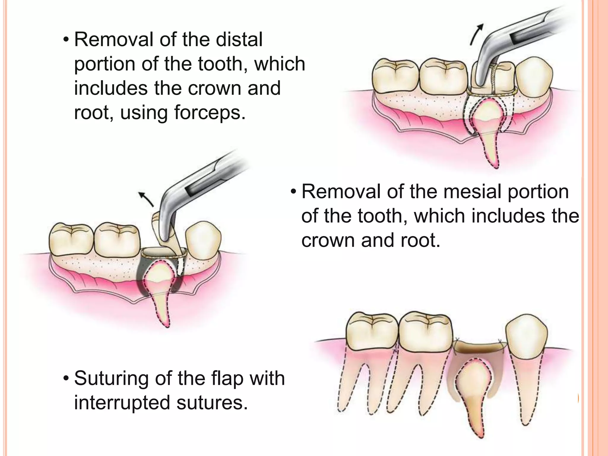 • Removal of the mesial portion
of the tooth, which includes the
crown and root.
• Suturing of the flap with
interrupted sutures.
• Removal of the distal
portion of the tooth, which
includes the crown and
root, using forceps.
 