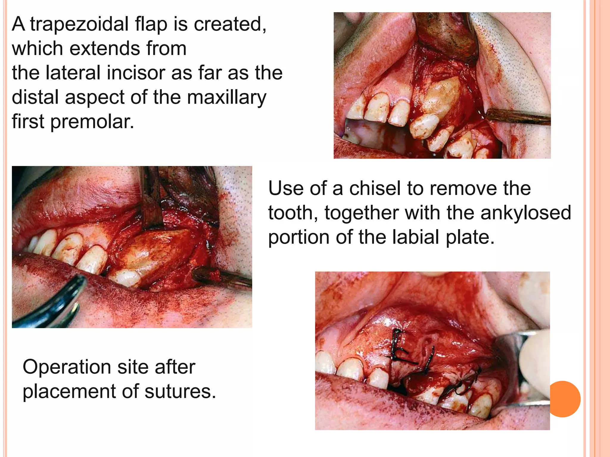 A trapezoidal flap is created,
which extends from
the lateral incisor as far as the
distal aspect of the maxillary
first premolar.
Use of a chisel to remove the
tooth, together with the ankylosed
portion of the labial plate.
Operation site after
placement of sutures.
 