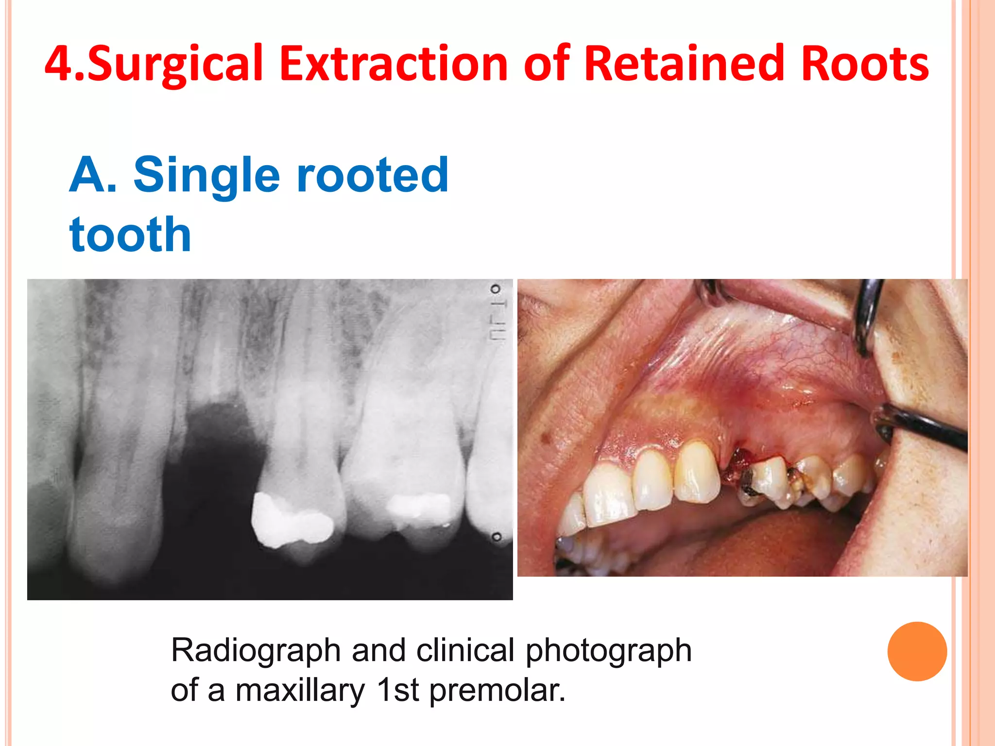 4.Surgical Extraction of Retained Roots
A. Single rooted
tooth
Radiograph and clinical photograph
of a maxillary 1st premolar.
 
