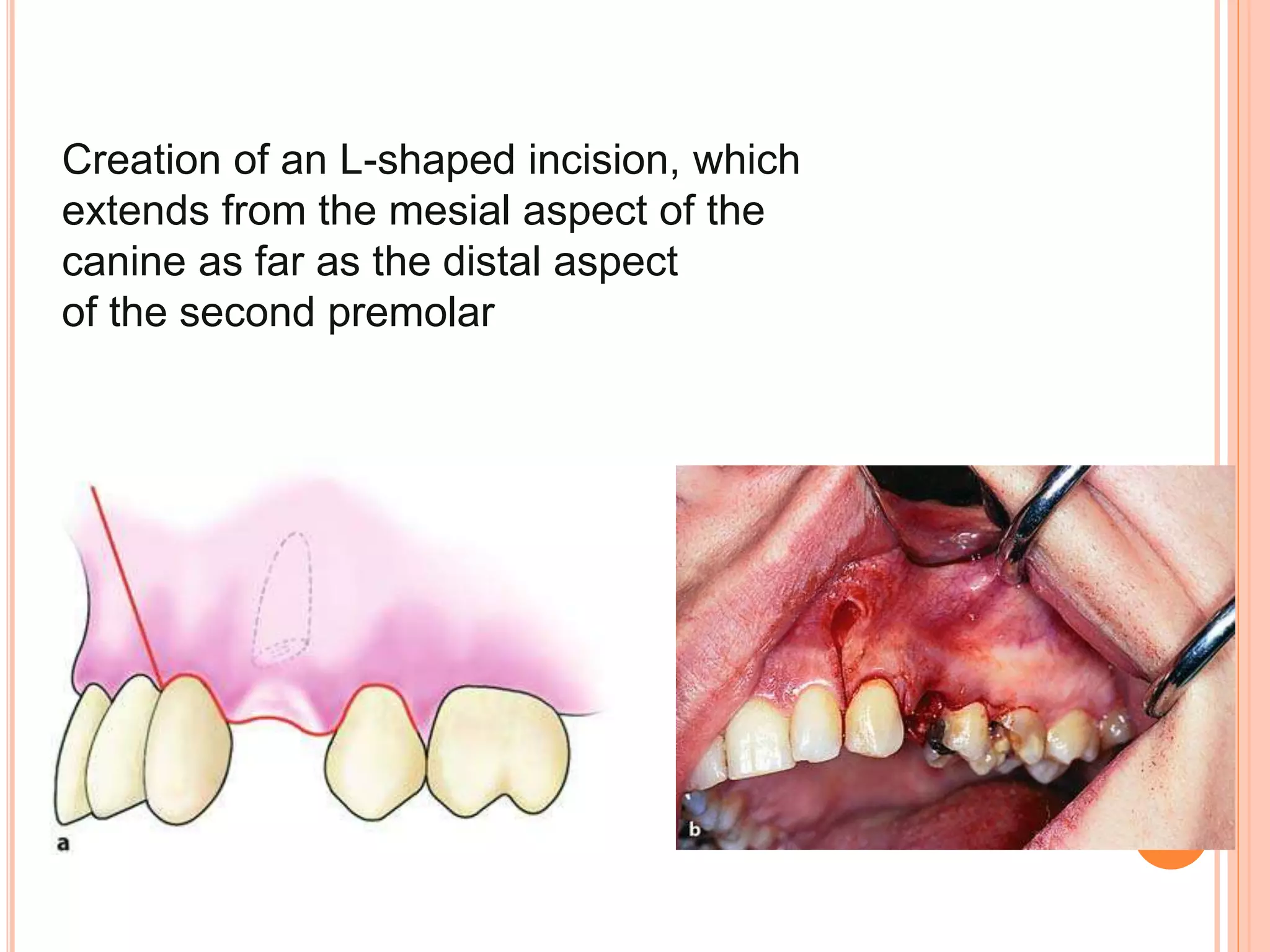 Creation of an L-shaped incision, which
extends from the mesial aspect of the
canine as far as the distal aspect
of the second premolar
 