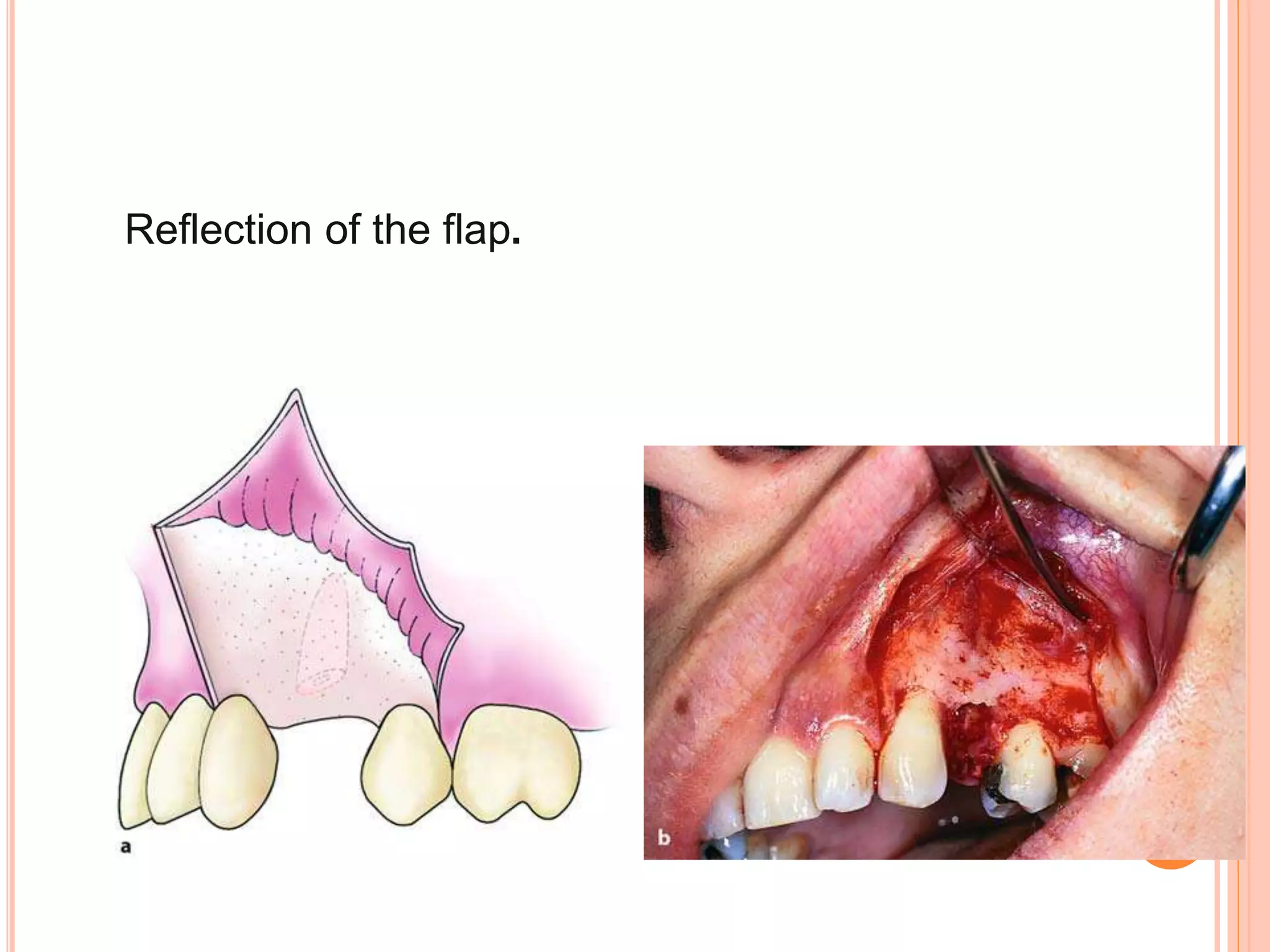 Reflection of the flap.
 