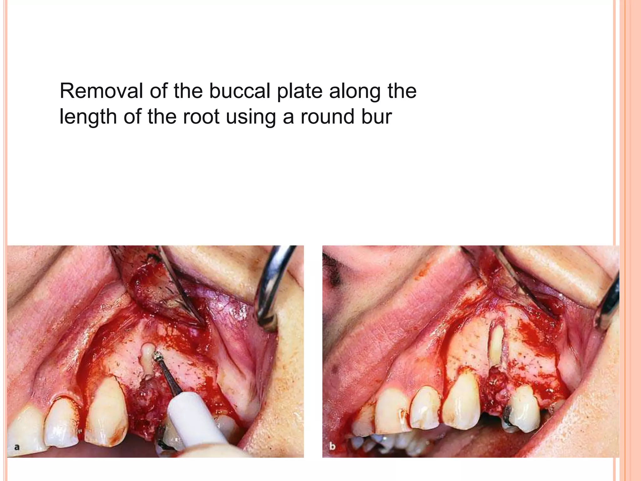 Removal of the buccal plate along the
length of the root using a round bur
 