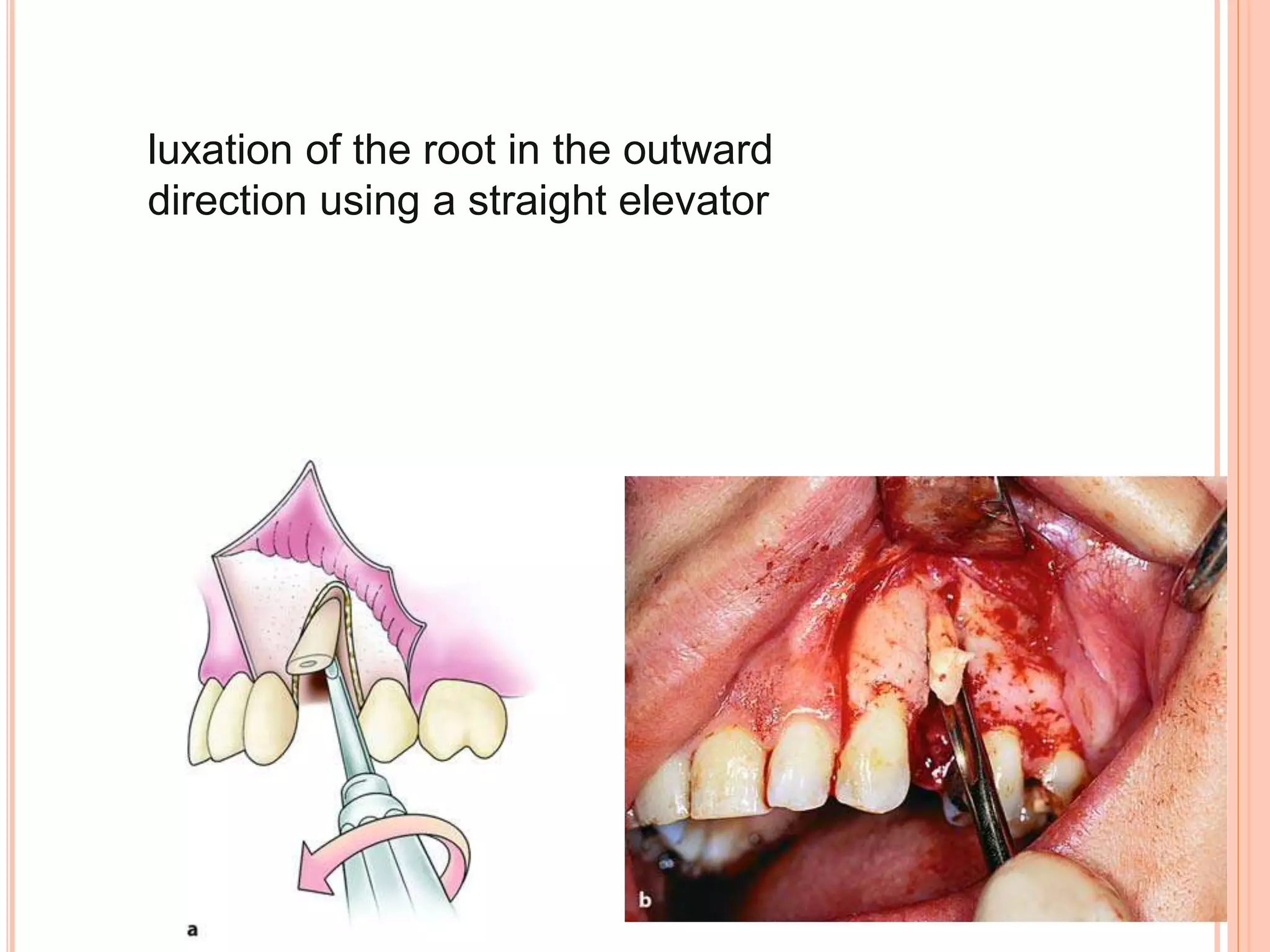 luxation of the root in the outward
direction using a straight elevator
 