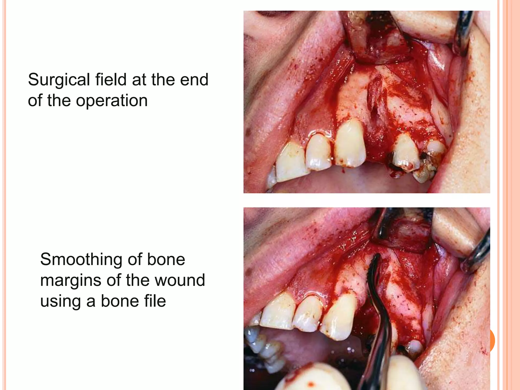 Surgical field at the end
of the operation
Smoothing of bone
margins of the wound
using a bone file
 