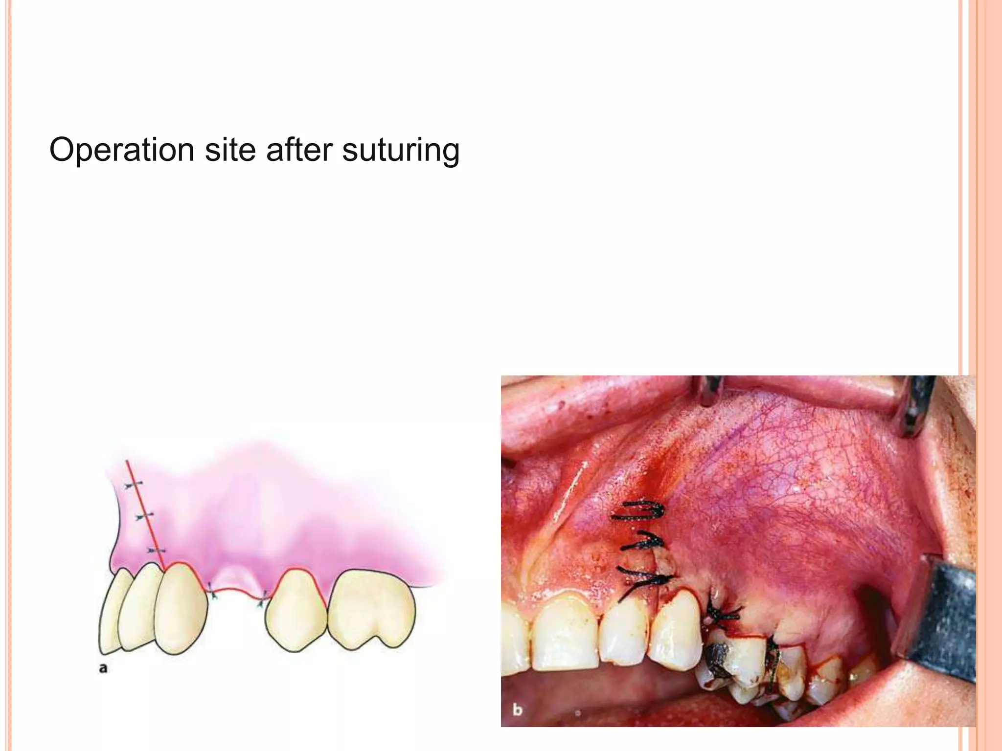 Operation site after suturing
 