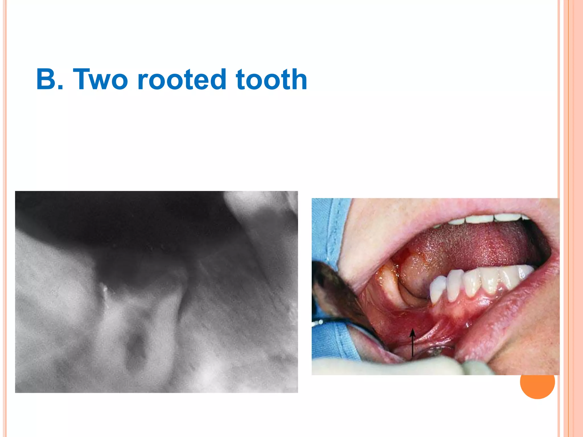 B. Two rooted tooth
 